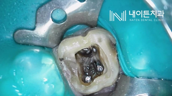 Treatment case image 2