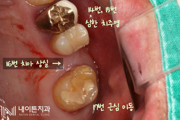 Treatment case image 1
