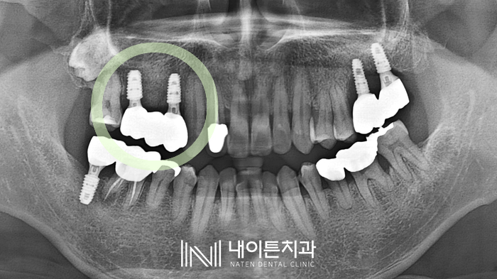 Treatment case image 3