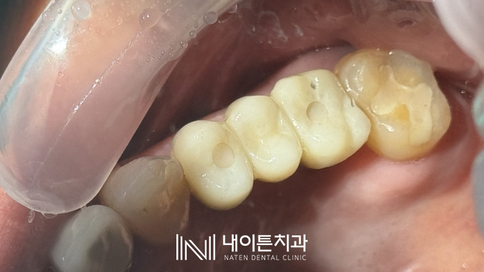 Treatment case image 4