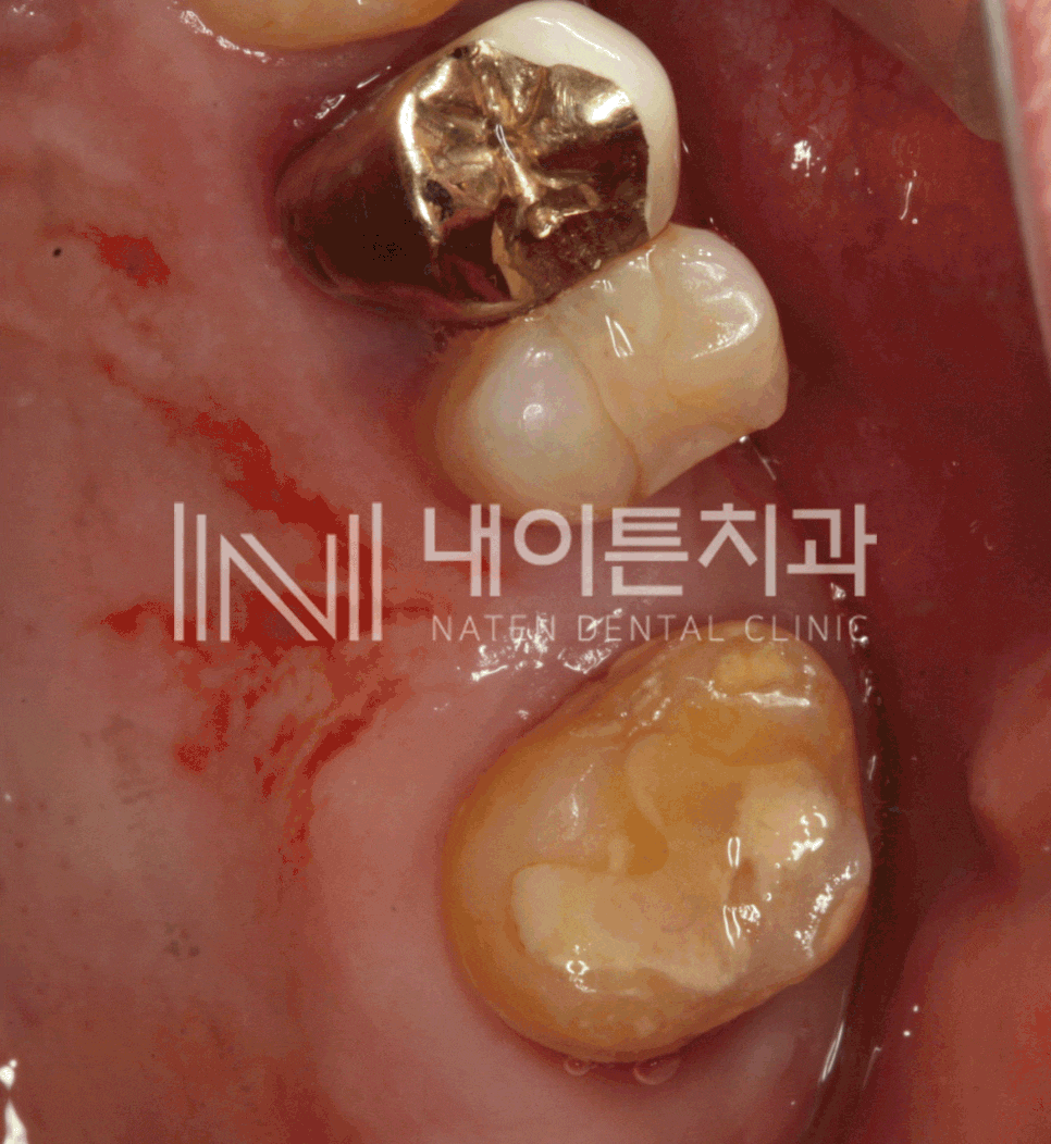 Treatment case image 5