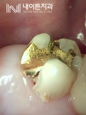 Treatment case image 2