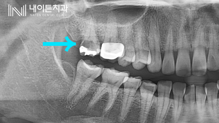 Treatment case image 3