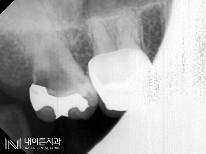 Treatment case image 4