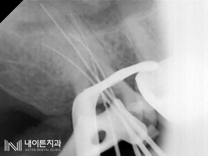 Treatment case image 9