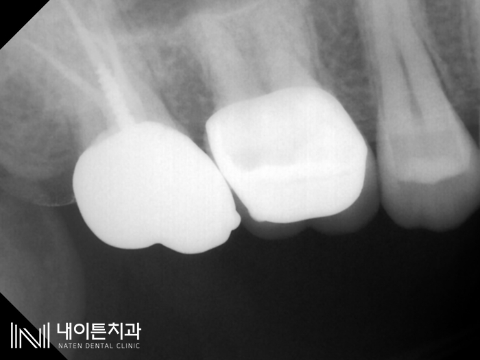 Treatment case image 11