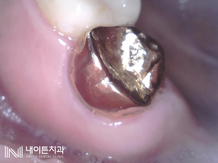 Treatment case image 14