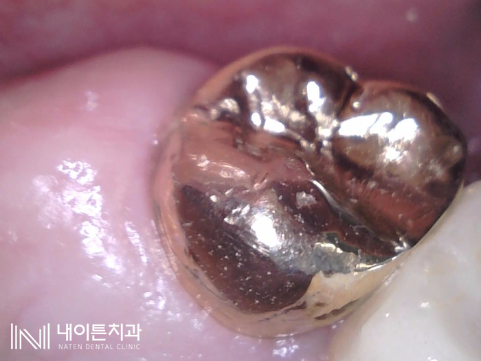 Treatment case image 15