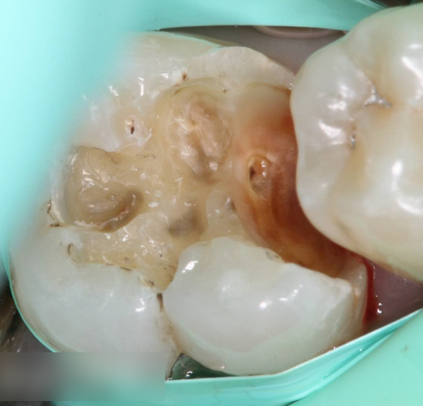 Treatment case image 3