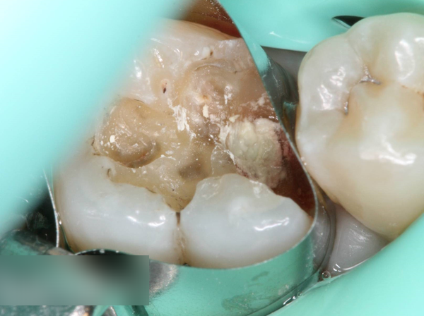 Treatment case image 5