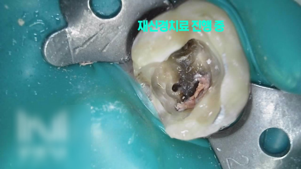 Treatment case image 5