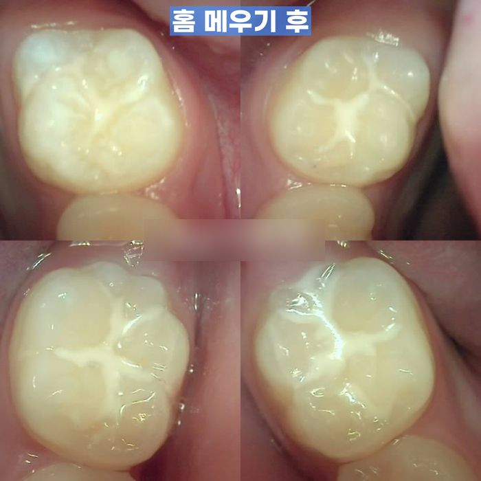 Treatment case image 6