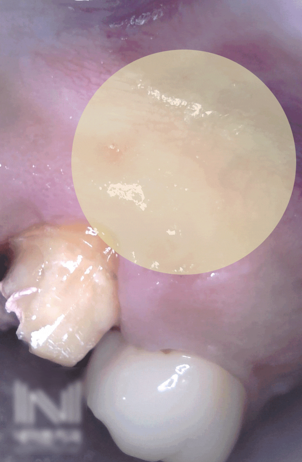 Treatment case image 3