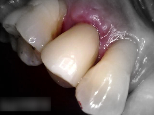 Treatment case image 14