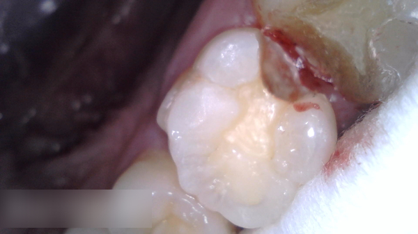 Treatment case image 2