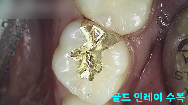 Treatment case image 4