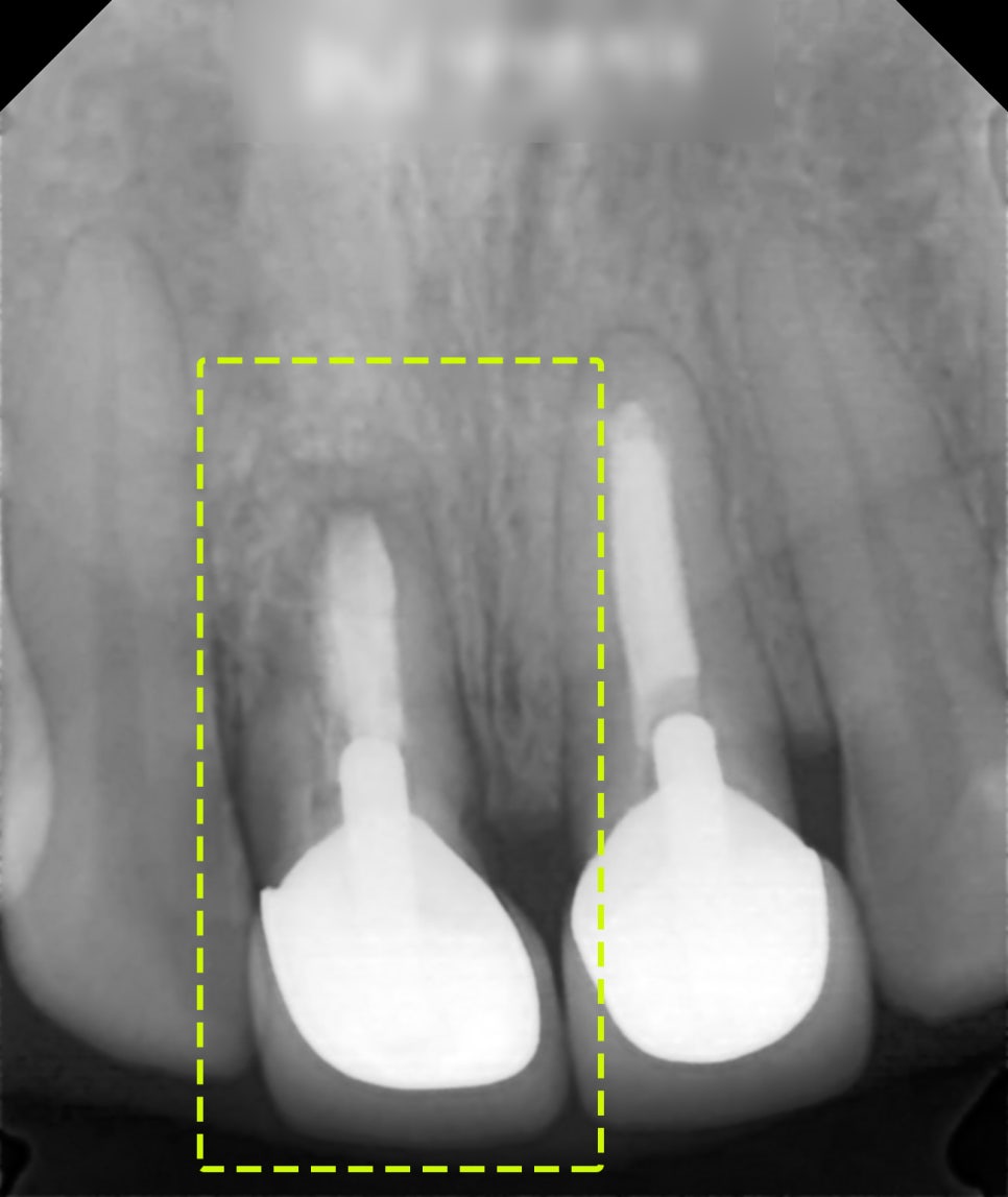 Treatment case image 2