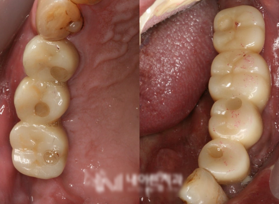 Treatment case image 2