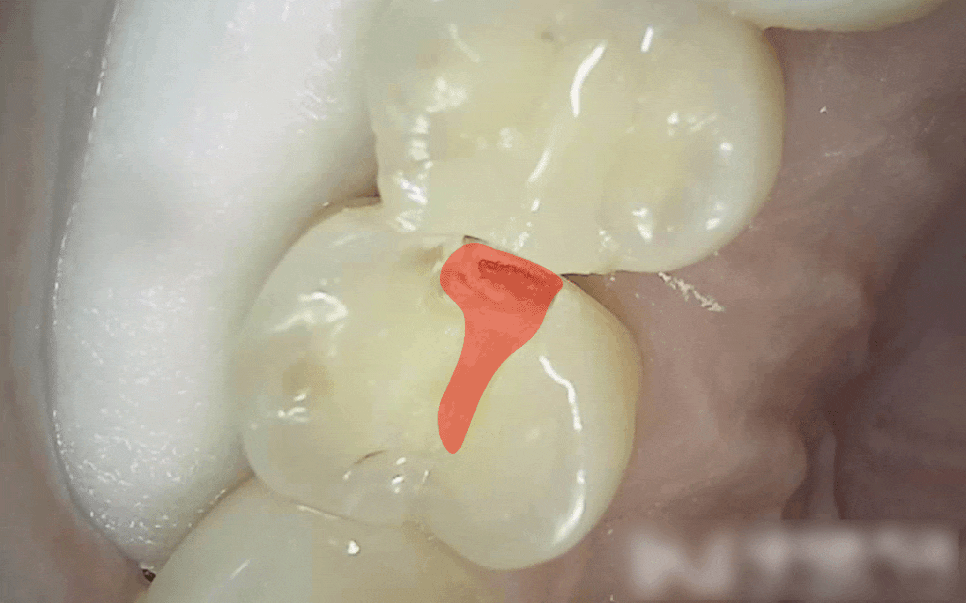 Treatment case image 2