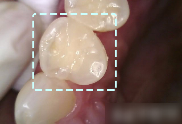 Treatment case image 6