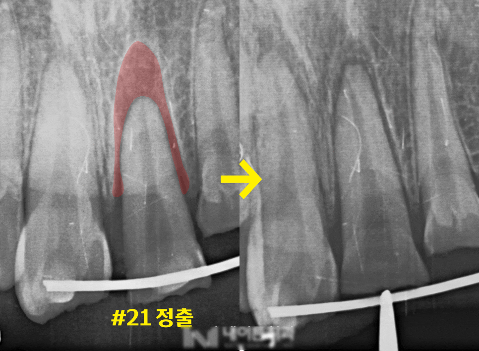 Treatment case image 2