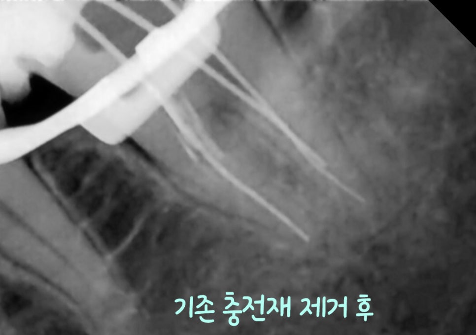 Treatment case image 3