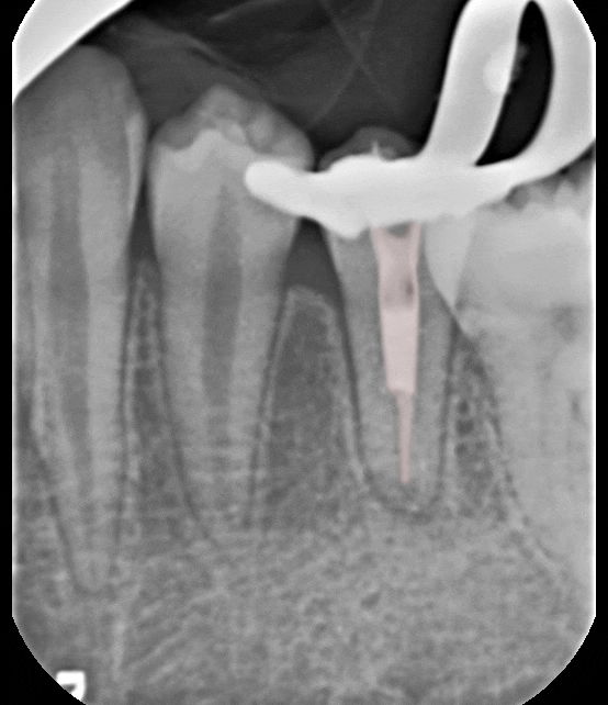 Treatment case image 6