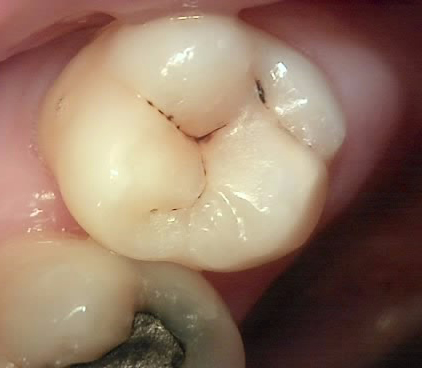 Treatment case image 2