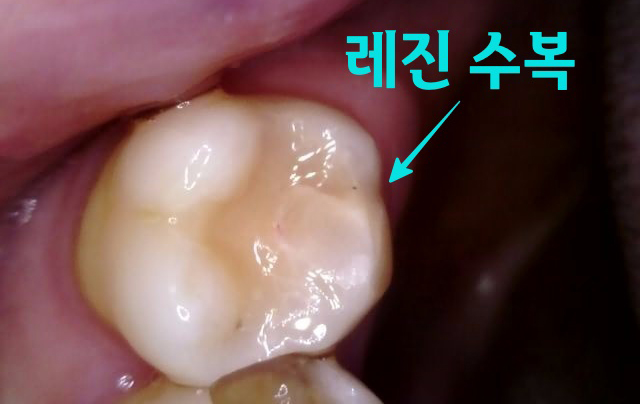 Treatment case image 5