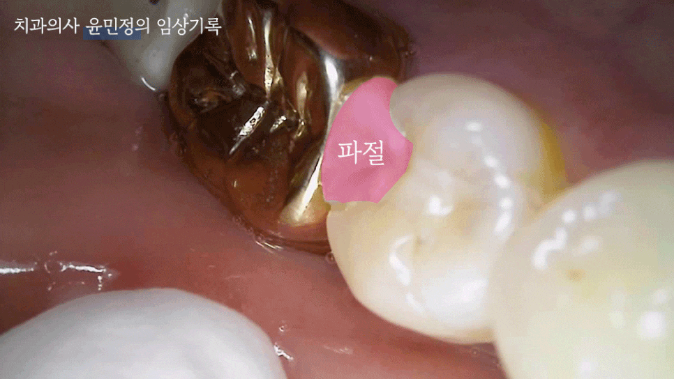 Treatment case image 2