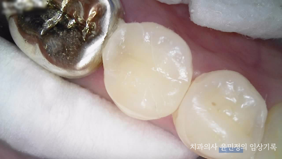 Treatment case image 5