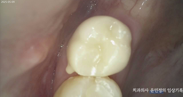 Treatment case image 5