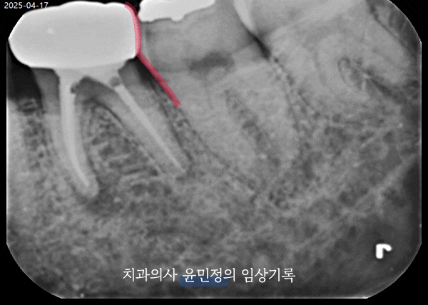 Treatment case image 2