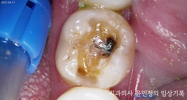 Treatment case image 5