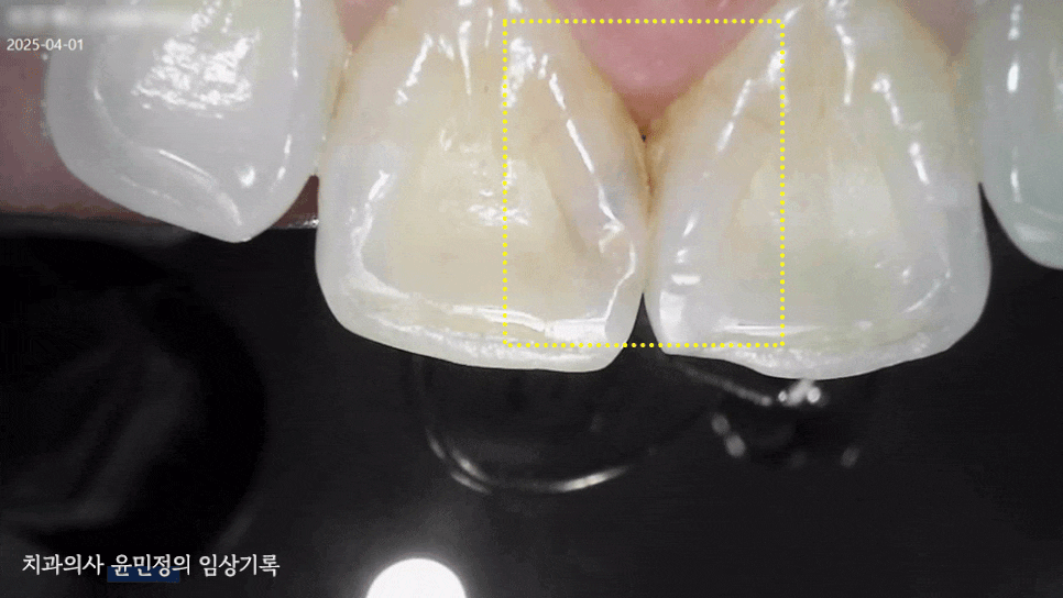 Treatment case image 2