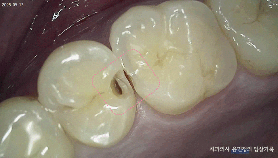 Treatment case image 5