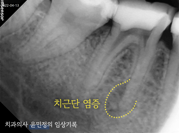 Treatment case image 3