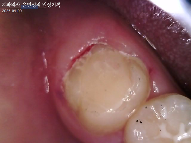 Treatment case image 5