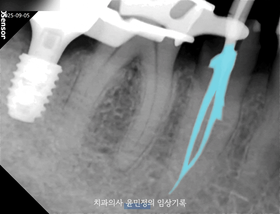 Treatment case image 5