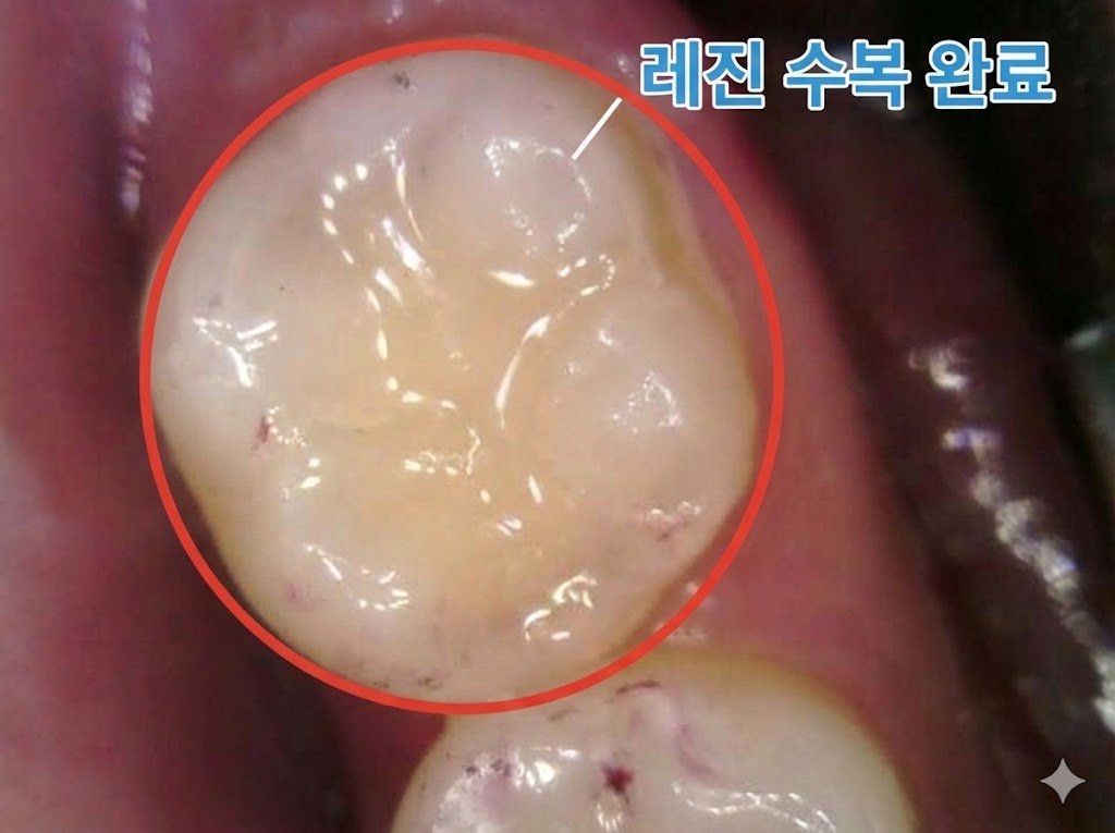 레진 치료 완료 후 사진