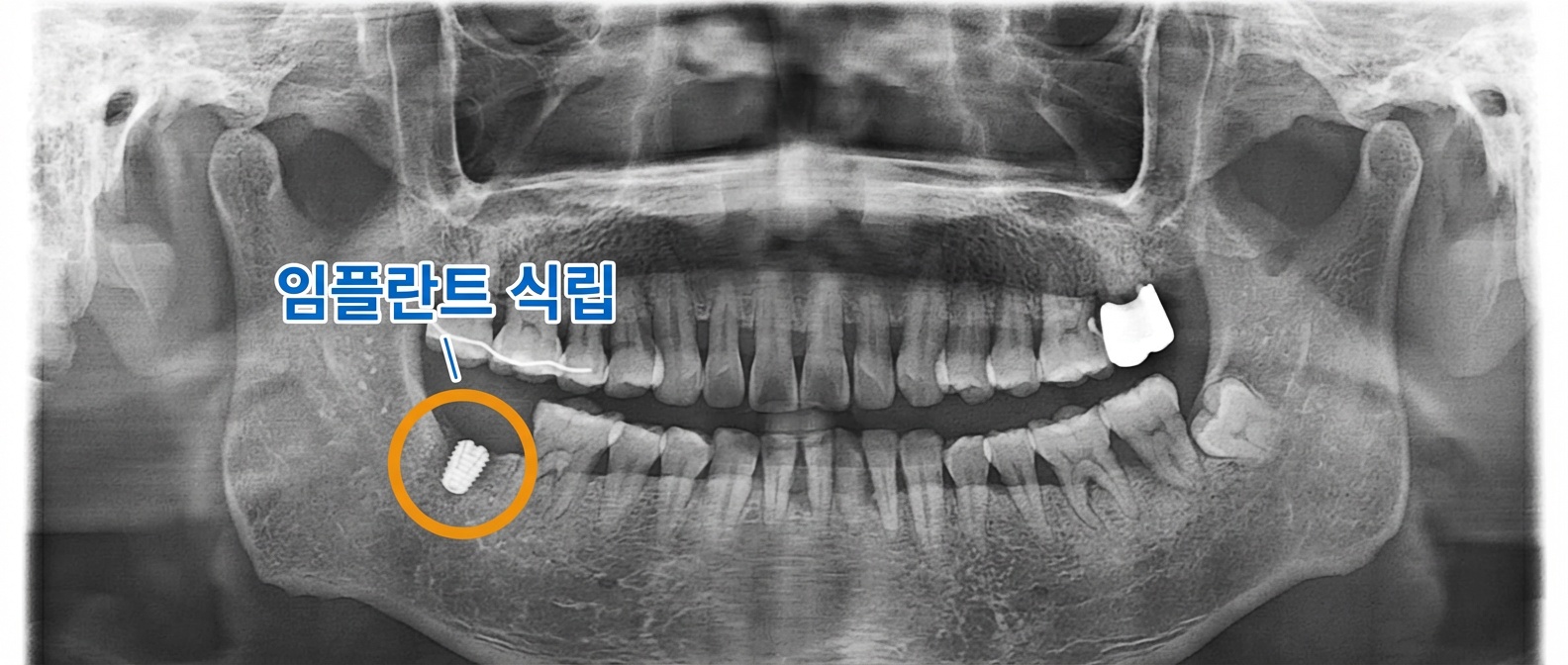 치료 과정 중 파노라마 엑스레이 사진