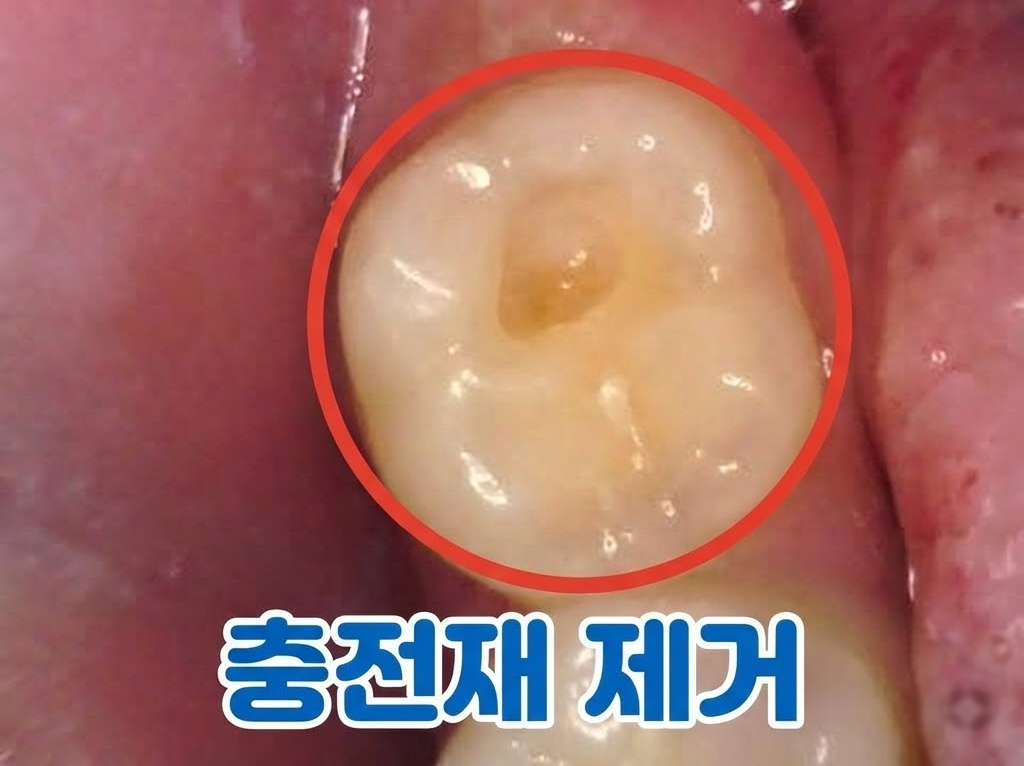 충전재 제거 후 모습