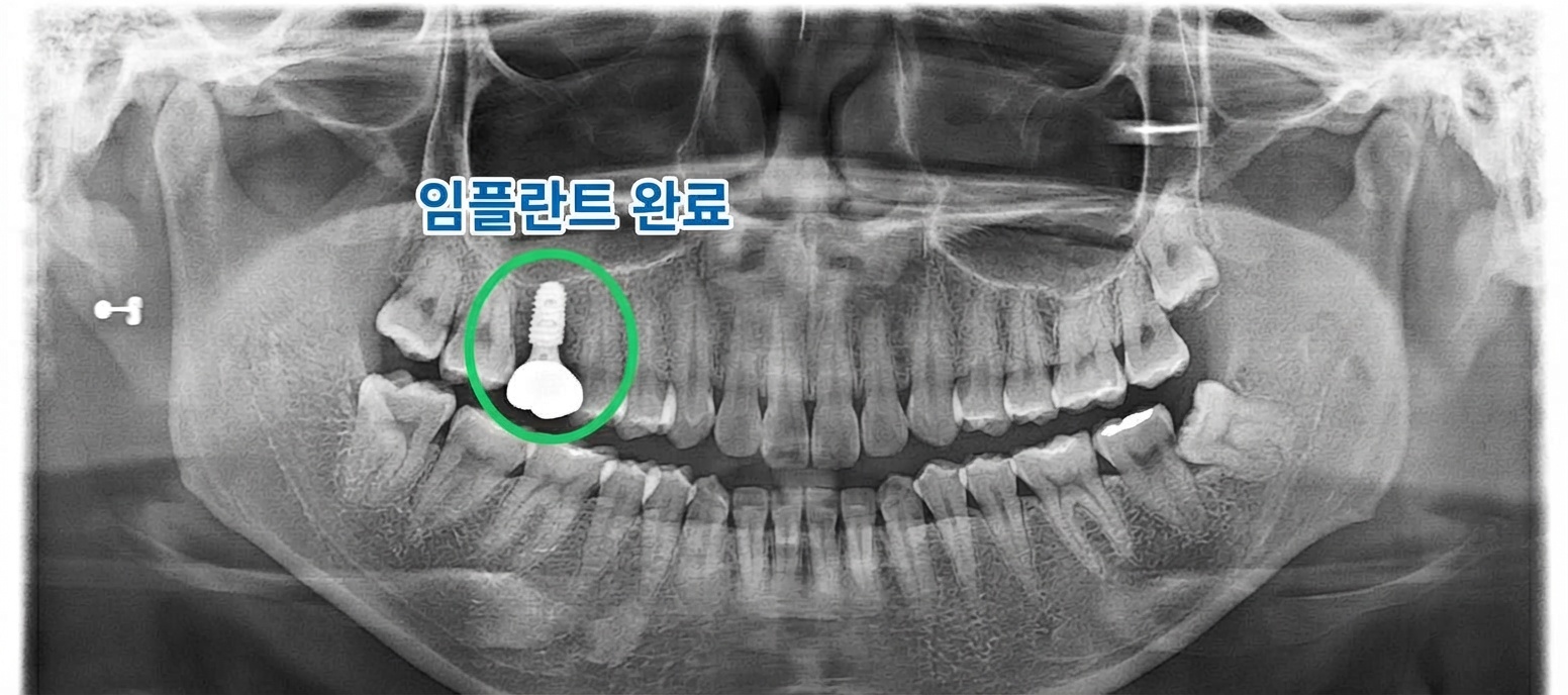 최종 보철물 체결 후 파노라마 X-ray