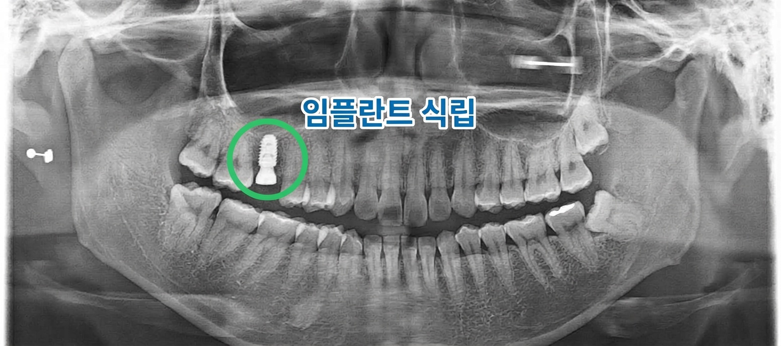 임플란트 식립 후 파노라마 X-ray
