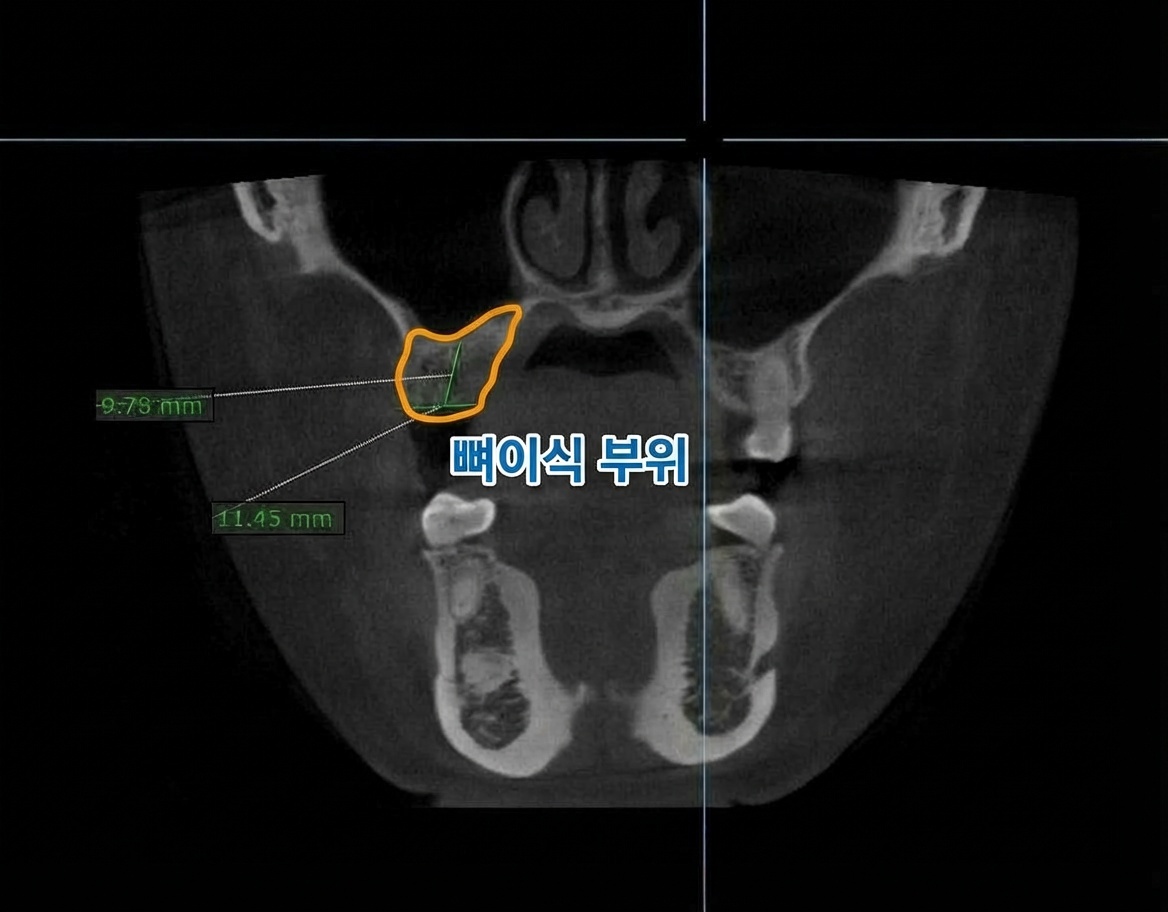 치조골이식술 후 CT 영상