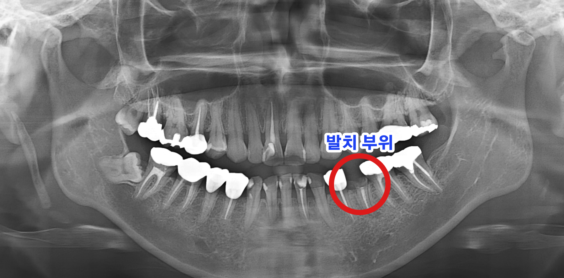 치료 전 발치된 치아 부위