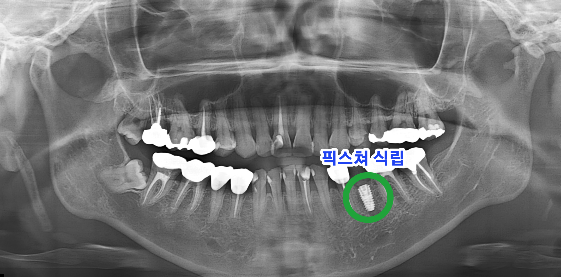 임플란트 픽스쳐가 식립된 엑스레이 사진