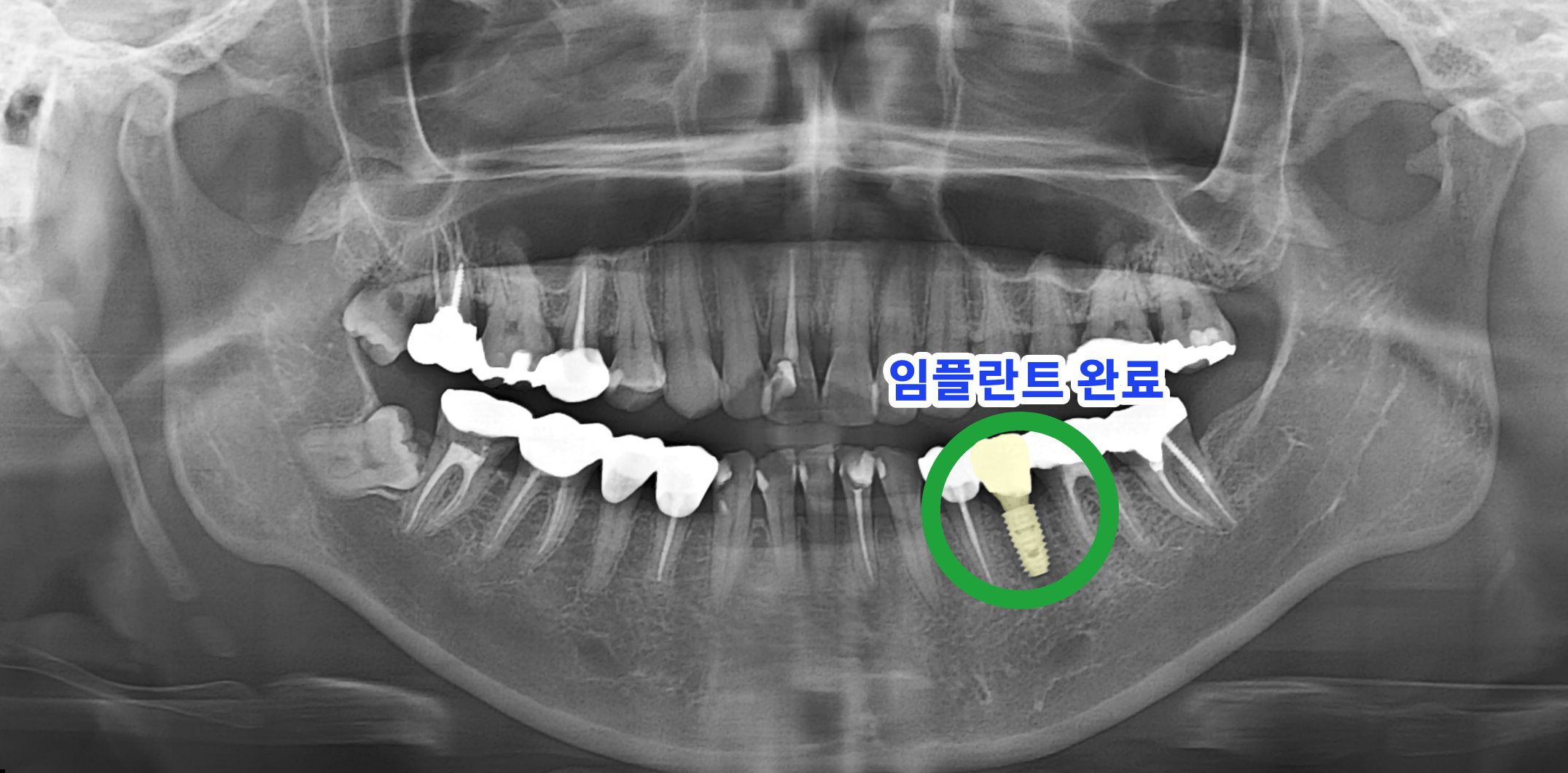 치료 후 임플란트 식립 완료