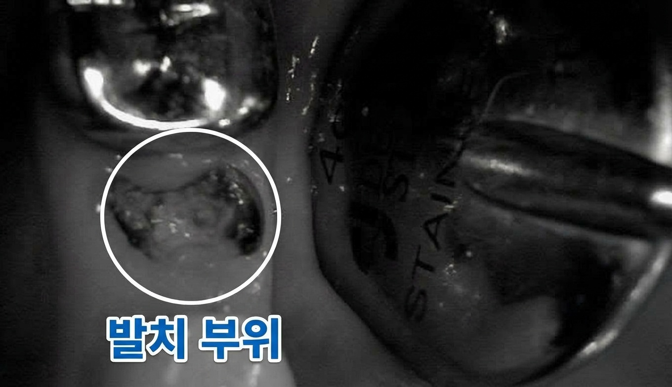 35번 치아가 발치된 상태의 구강 사진