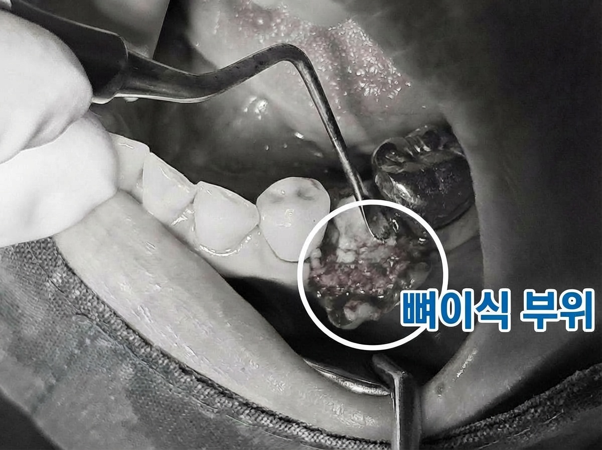 임플란트 픽스쳐 식립 후 인공뼈 이식 진행 사진